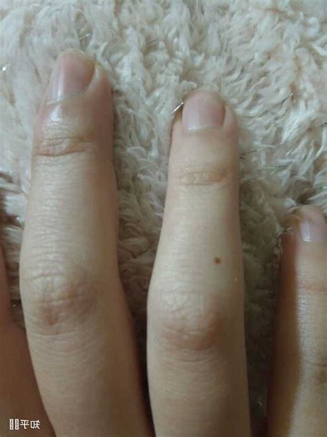 左手無名指 痣